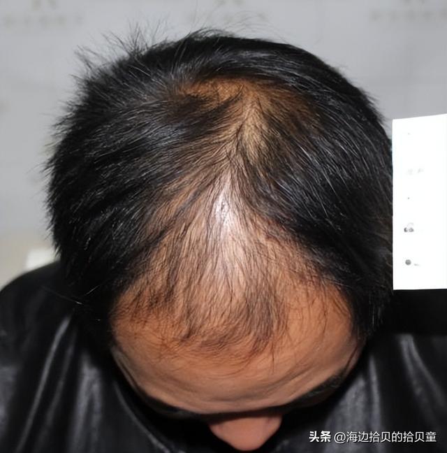 最好？育发液什么牌子最有效果？MG不朽情缘日本生发液哪个牌子